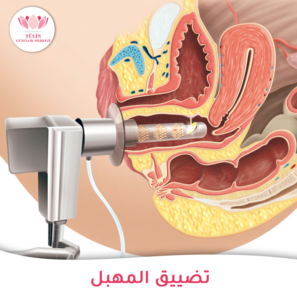 عملية تضييق المهبل بعد الولادة بالليزر - اللجوء الي عملية التضييق المهبلي 529