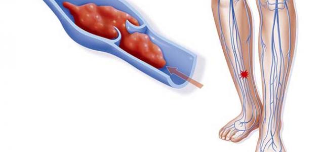 علاج الجلطة في الرجل , علامات و اسباب تجاط القدم