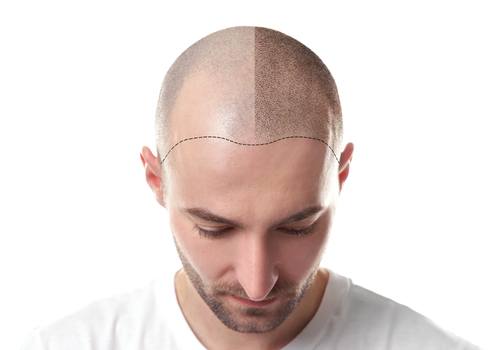 كم تكلفة زراعة الشعر , تكاليف زراعه الشعر بتقنيه الشريحه و الاقتطاف