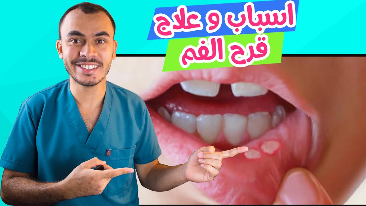 علاج التهاب الفم واللثة- اكثر علاج فعال لامراض اللثة والاسنان 6620