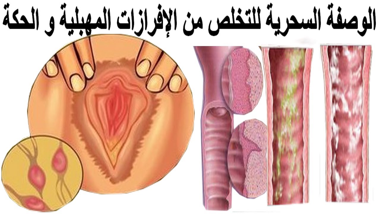 كيف اتخلص من الافرازات المهبلية والرائحة الكريهة , اعاني من الافرازات كيفية التخلص منها