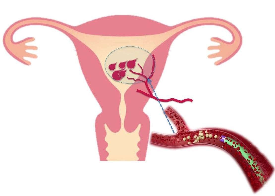 علاج نزيف الرحم , مسببات النزف من الرحم و كيفية التعامل معها