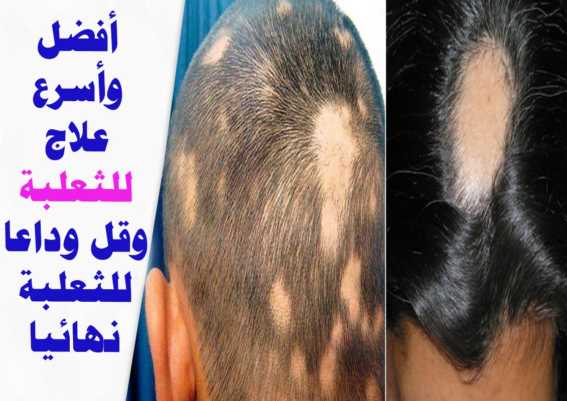 افضل علاج للثعلبة , كيفية علاج الثعلبة