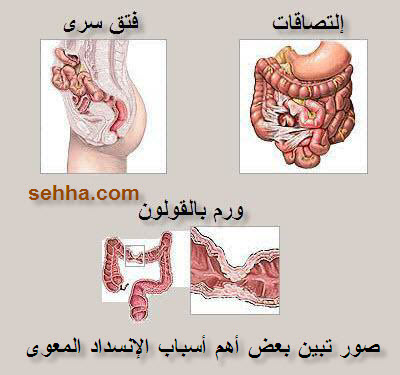 امراض الامعاء واعراضها - امراض الامعاء الدقيقه و الغليظه 1016 1