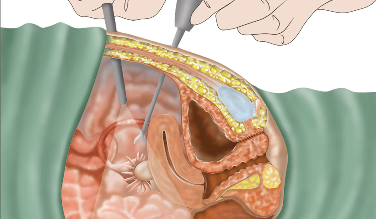 اسعار عملية تضييق المهبل بالليزر - تجميل المهبل حديثا بالليزر 3729