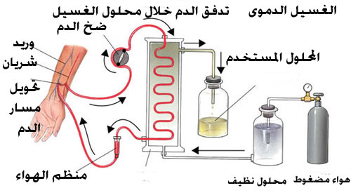 ما هو غسيل الكلى - غسيل الكلي امر صعب 1683 2