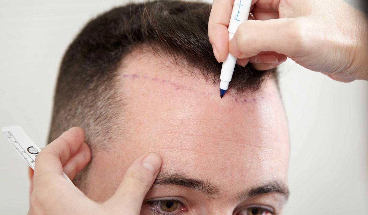 تكاليف زراعة الشعر , اريد زراعة شعري باقل الاسعار